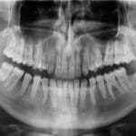 Bone Shattered for Beauty